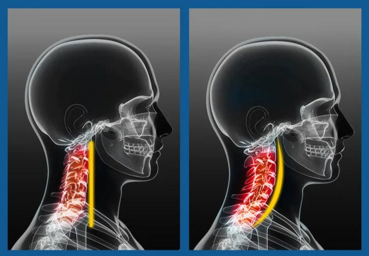 DreamEase Neck ReAligner